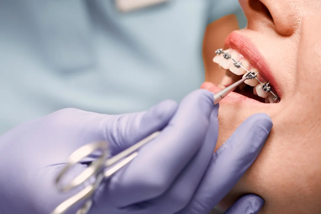 брекети или invisalign